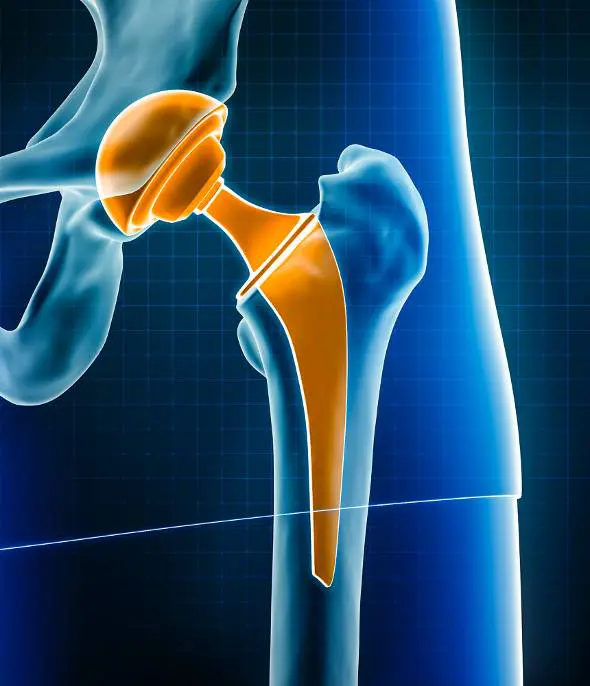 Total Joint Replacement