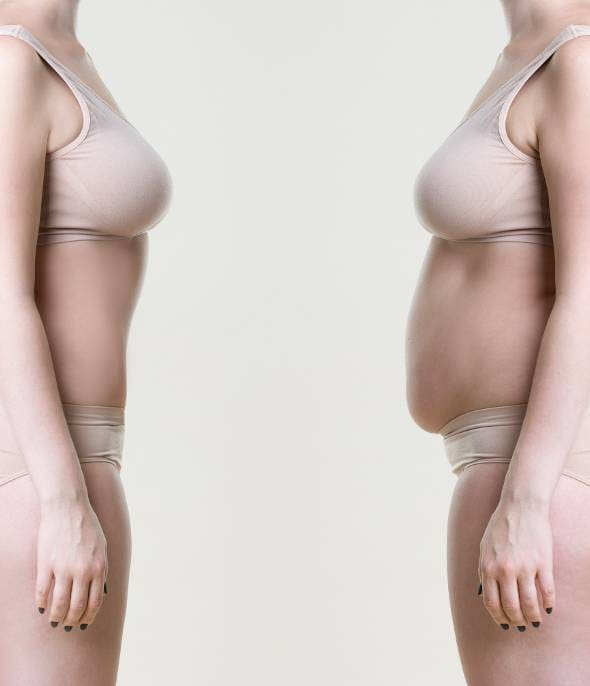 Liposuction